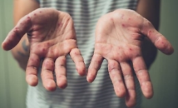 Allarme morbillo in Sicilia: incidenza di casi più alta d'Italia