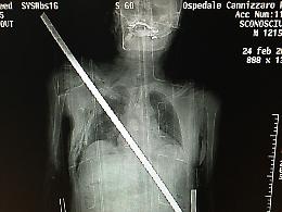 &laquo;Io, trafitto da una barra di ferro salvato dagli "angeli" del Cannizzaro&raquo;
