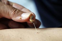 In shock anafilattico dopo puntura di vespa: 40enne salvato in extremis