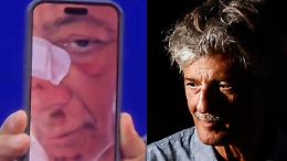 «Atterro di faccia»: la caduta (autoironica) di Fiorello in bicicletta, il racconto dal palco e la foto delle ferite
